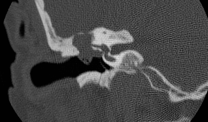 Colesteatoma e Otite Crônica Diagnóstico e Tratamento