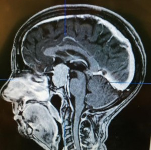 tumor no cérebro