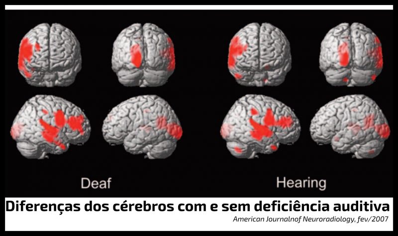 cérebro da pessoa com deficiência auditiva